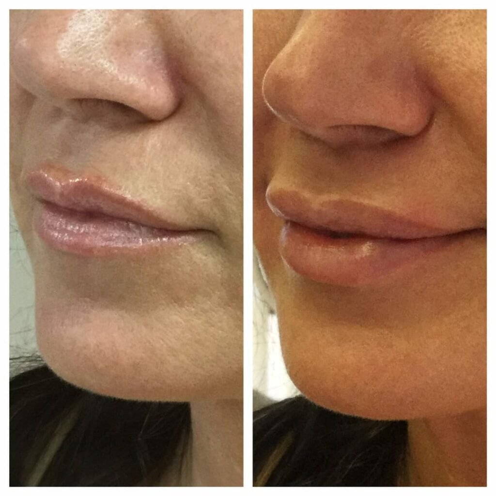 one syringe juvederm ultra xc in lips