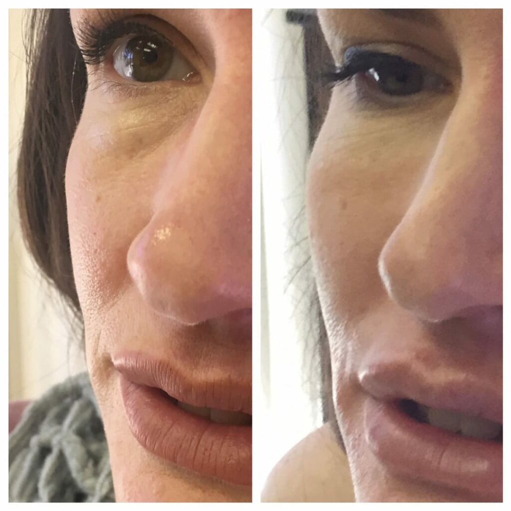 one syringe juvederm voluma in cheeks and tear troughs