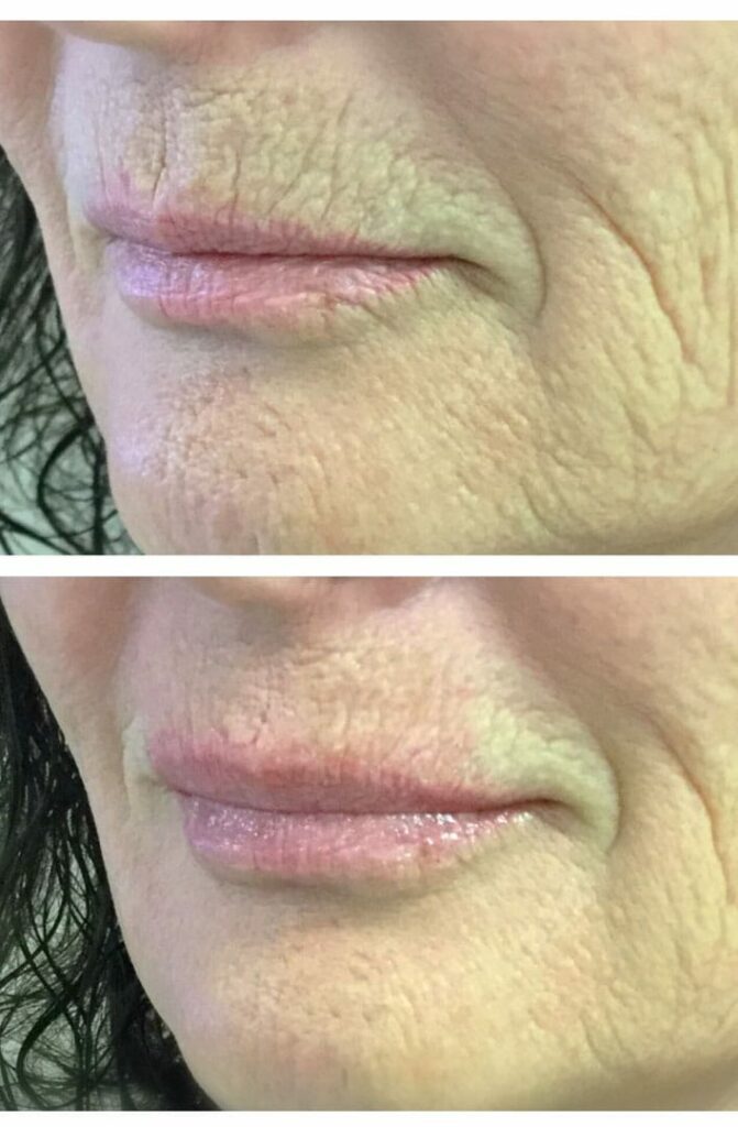 one syringe of juvederm volbella in the lips and lip linee
