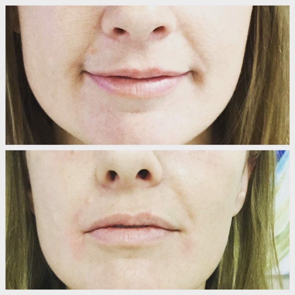 one syringe of juvederm vollure to nasolabial folds and oral commissures
