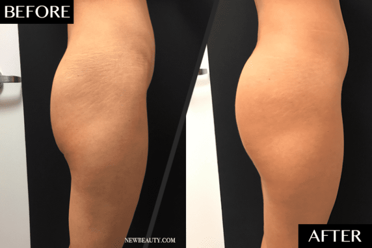 What is the difference between Emsculpt and Sculptra for non-surgical buttocks augmentation?
