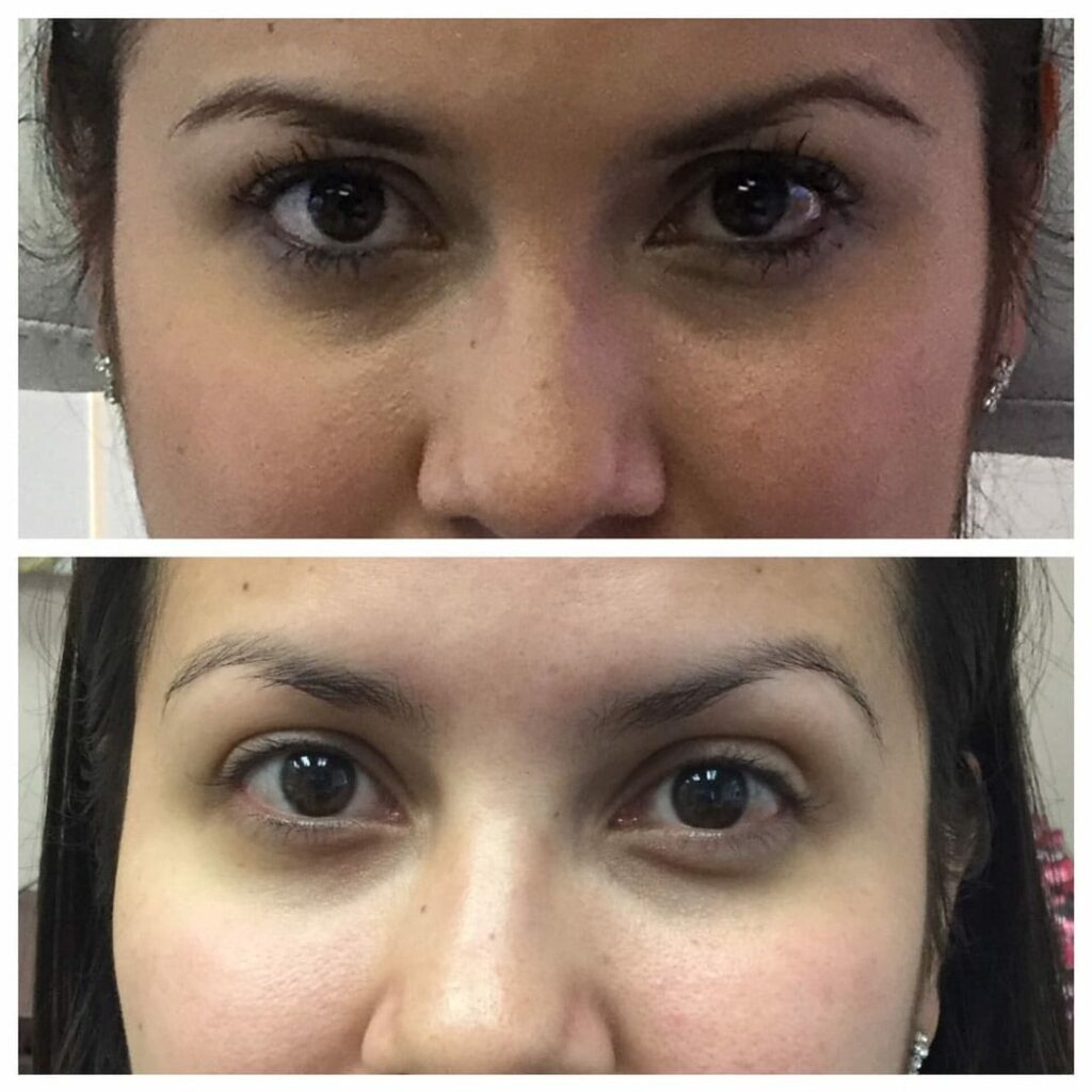 two months after patient was treated with Xeomin for a non-surgical brow lift