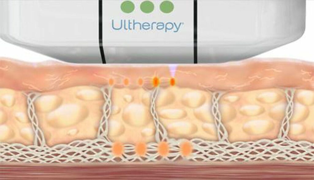 Ultherapy collagen building