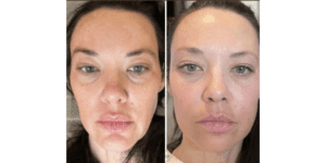 Sculptra neck & decollage lift