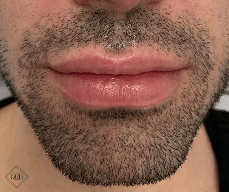 The Best Men’s Lip Filler: The Benefits Explained in This Ultimate Guide