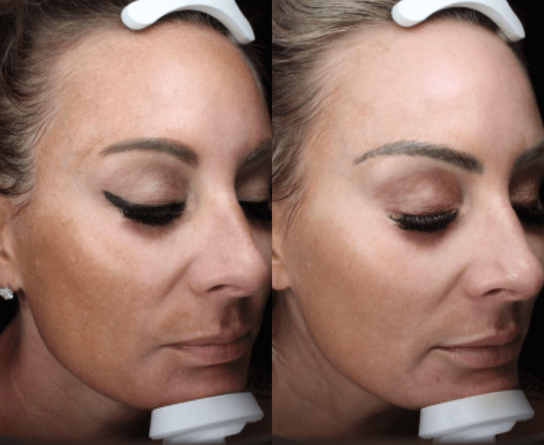 Clear and Brilliant Laser in Scottsdale DHH Med Spa