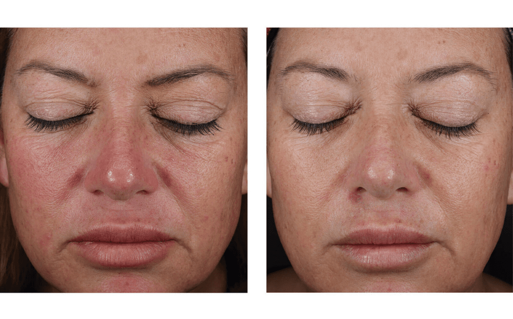 mystro before and after facial improvements