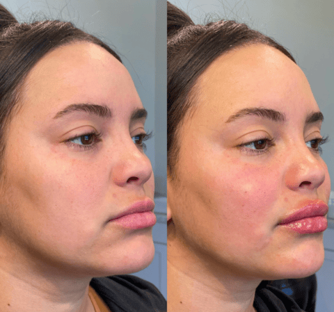 Versa Botox Revanesse Versa Injections in Scottsdale | DHH Med Spa