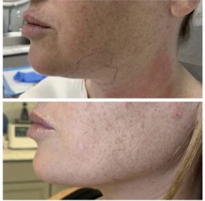 Agnes Precision RF Skin Tightening Treatment Before & After